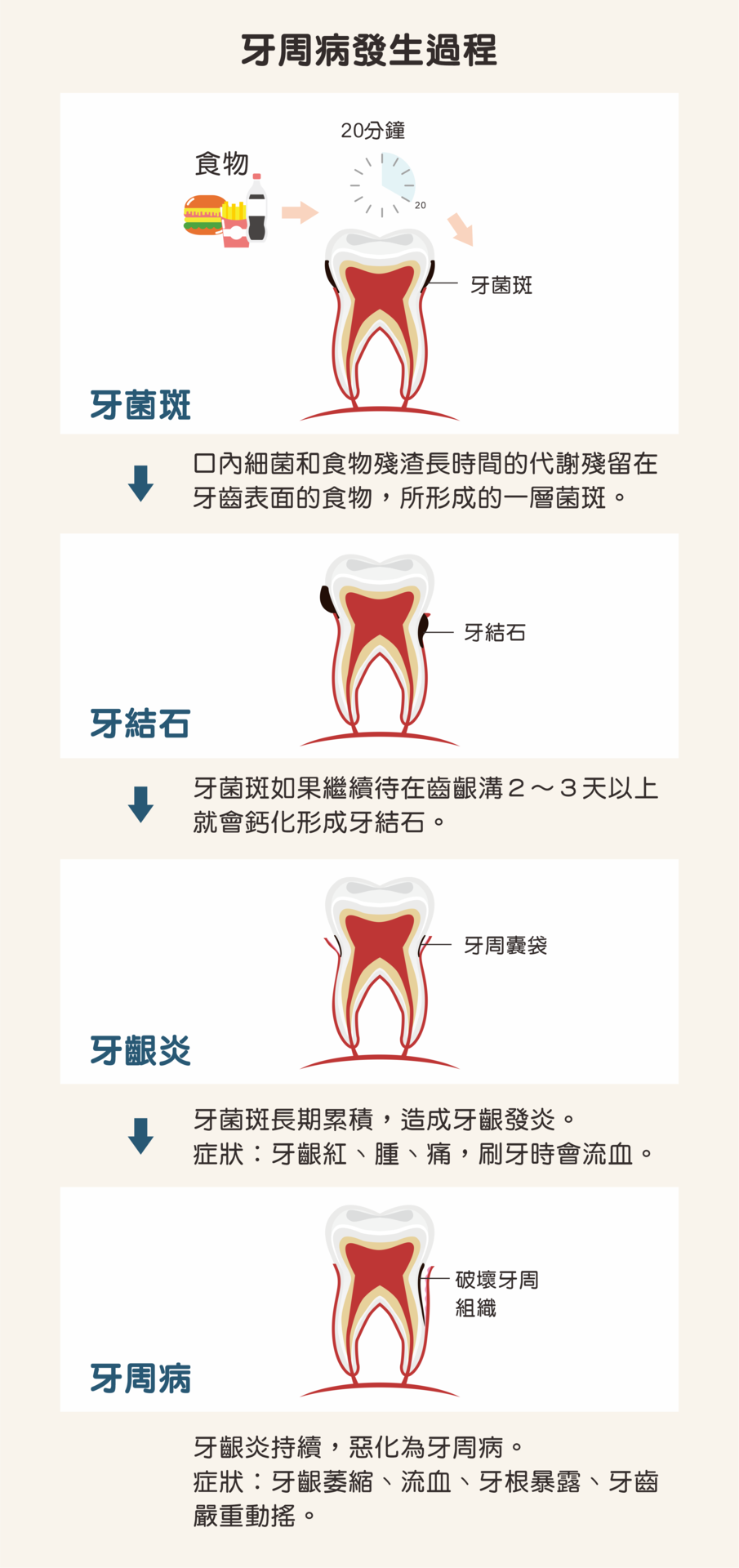 牙周病發生過程
